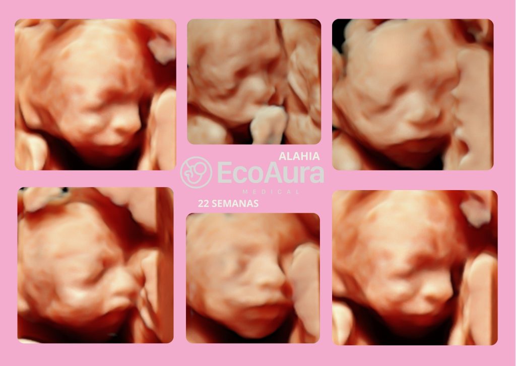 Ecografía 5D de bebé a las 33 semanas en Tenerife Sur en EcoAura Medical