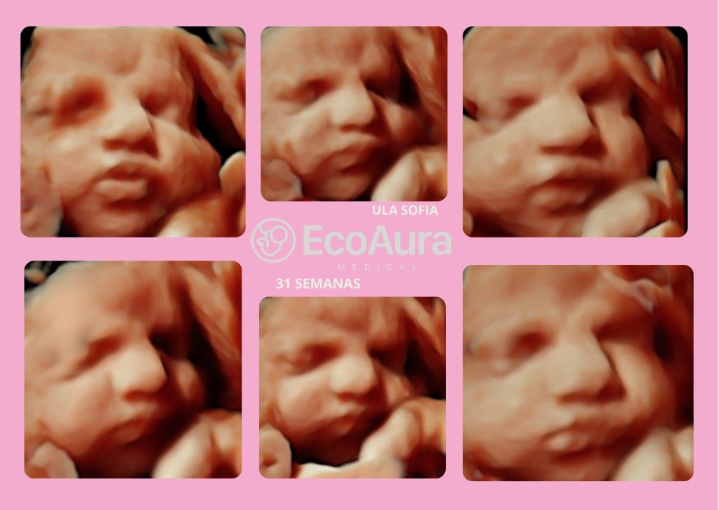 Ecografía 5D a las 31 semanas para saber el sexo del bebé en Tenerife