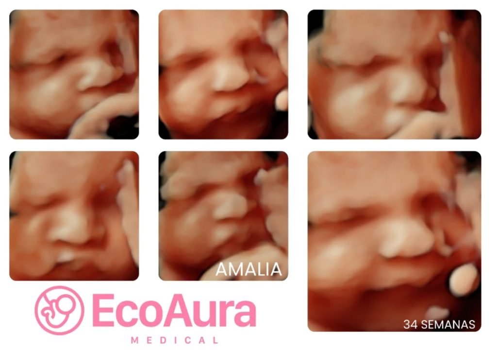 Ecografía 5D mostrando la cara del bebé a las 34 semanas en Tenerife